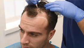 Hair Transplant