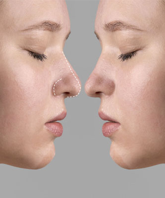 Nose Filler