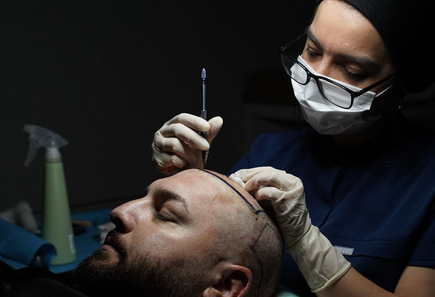 FUE Hair Transplant