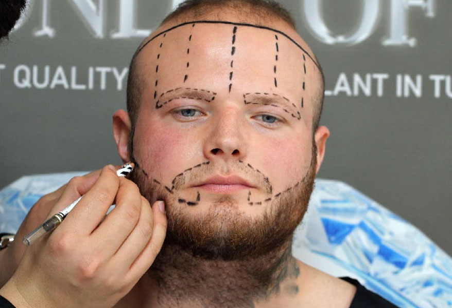 Eyebrow Transplant