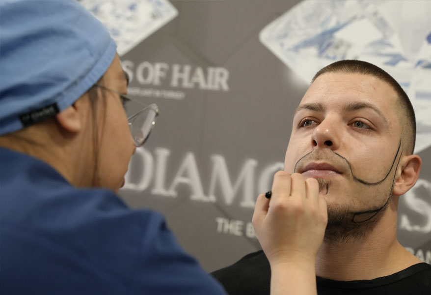 Beard Transplant
