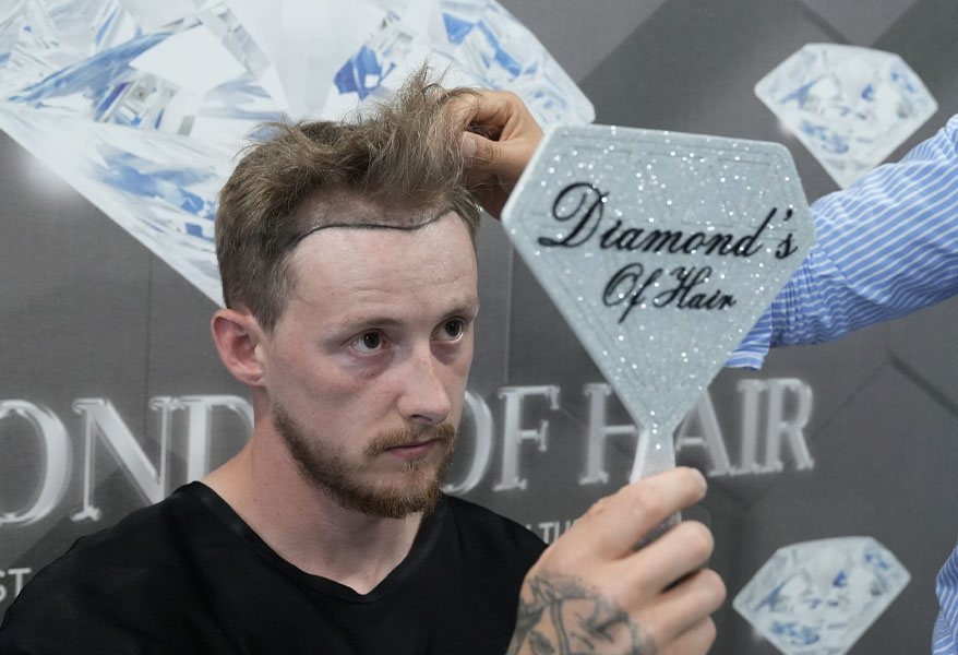Unshaven Hair Transplant