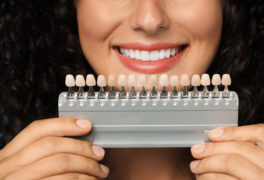 Emax Veneers