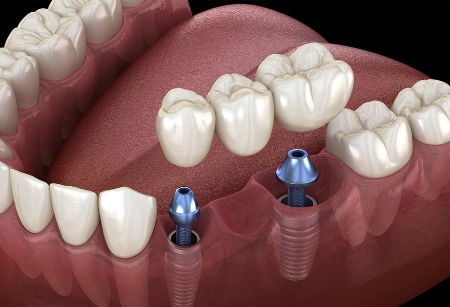 Dental Bridges