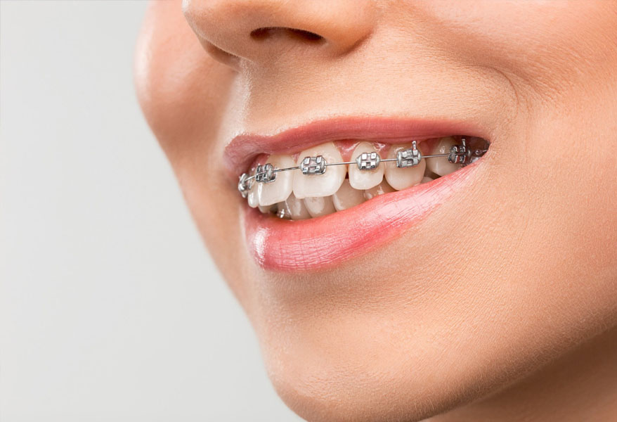 Braces