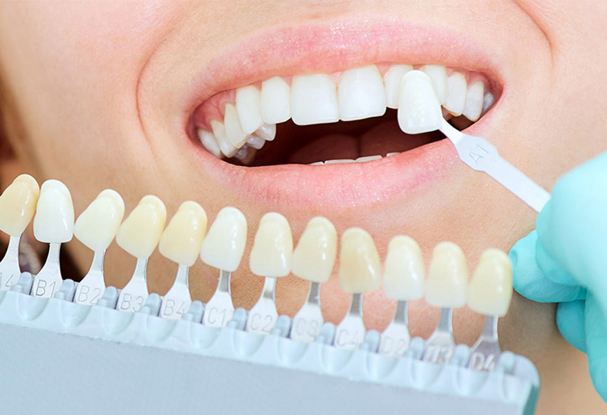 Porcelain Dental Veneers 